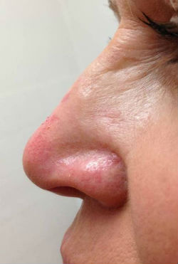 non surgical dermal filler nose job after NZ